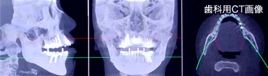 歯科用CT画像